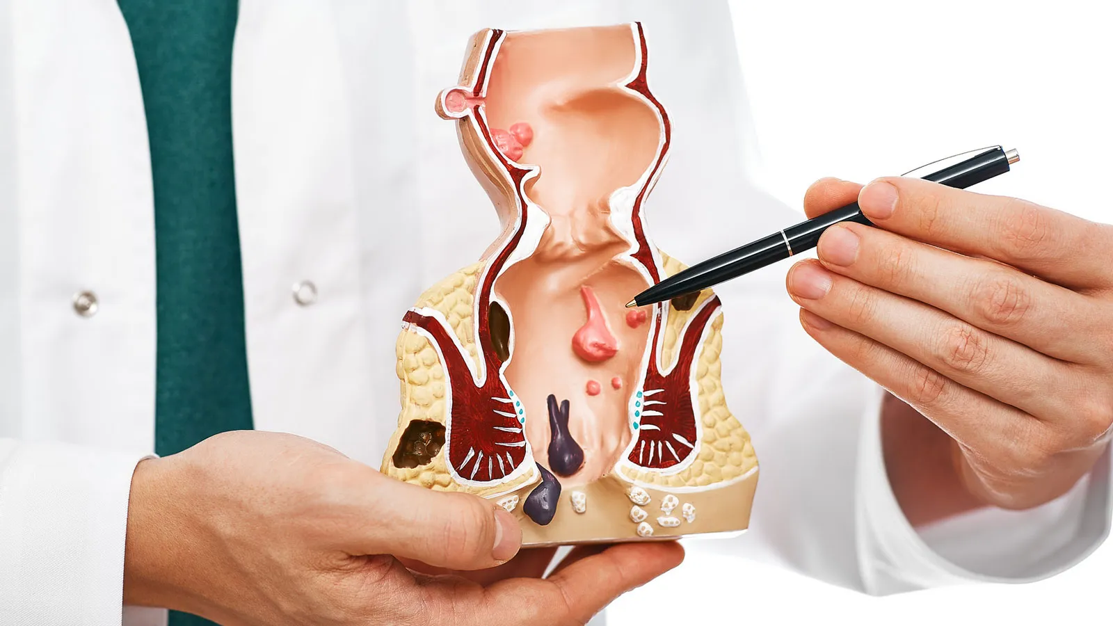 Understanding Hemorrhoids: Causes, Symptoms, and Modern Treatments