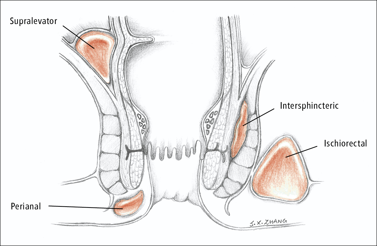 Types of Anorectal Abscess: Causes, Symptoms & When to See a Doctor
