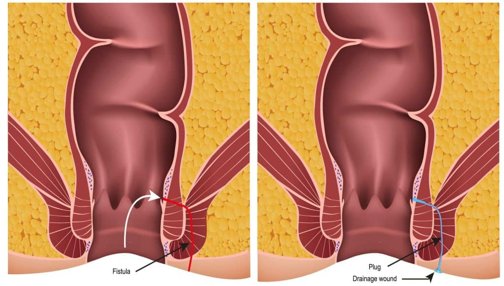 What Is VAAFT and How Does It Treat Fistula-in-Ano?
