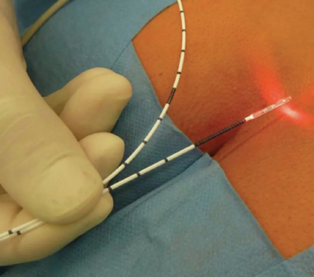 Laser surgery for fistula-in-ano