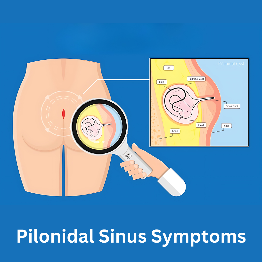 Pain and Discharge from a Hole Near the Tailbone – Could It Be Pilonidal Sinus?