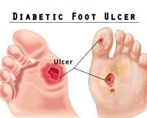 Diabetic Foot Ulcer